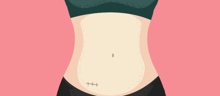 Can You Exercise with Stitches or After Surgery?