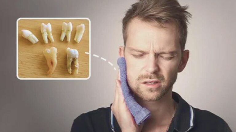 How Long After Wisdom Teeth Removal Can You Workout?