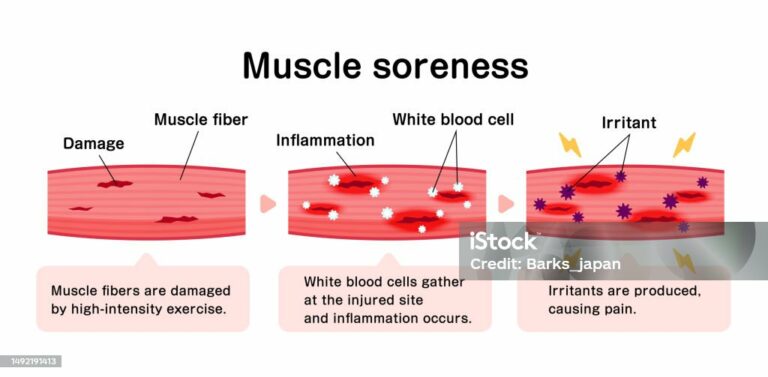 Why Muscles Get Sore After a Workout (Science Explained)